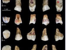 桐梓人牙齿形态研究新进展